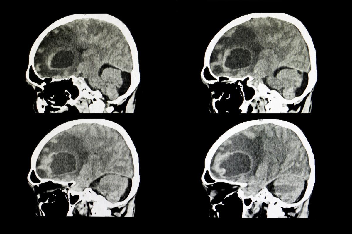 CT-Scan eines Gehirns eines Patienten mit einem großen metastasierten Tumor